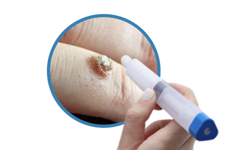Treatment for Stubborn Warts [VIDEO]